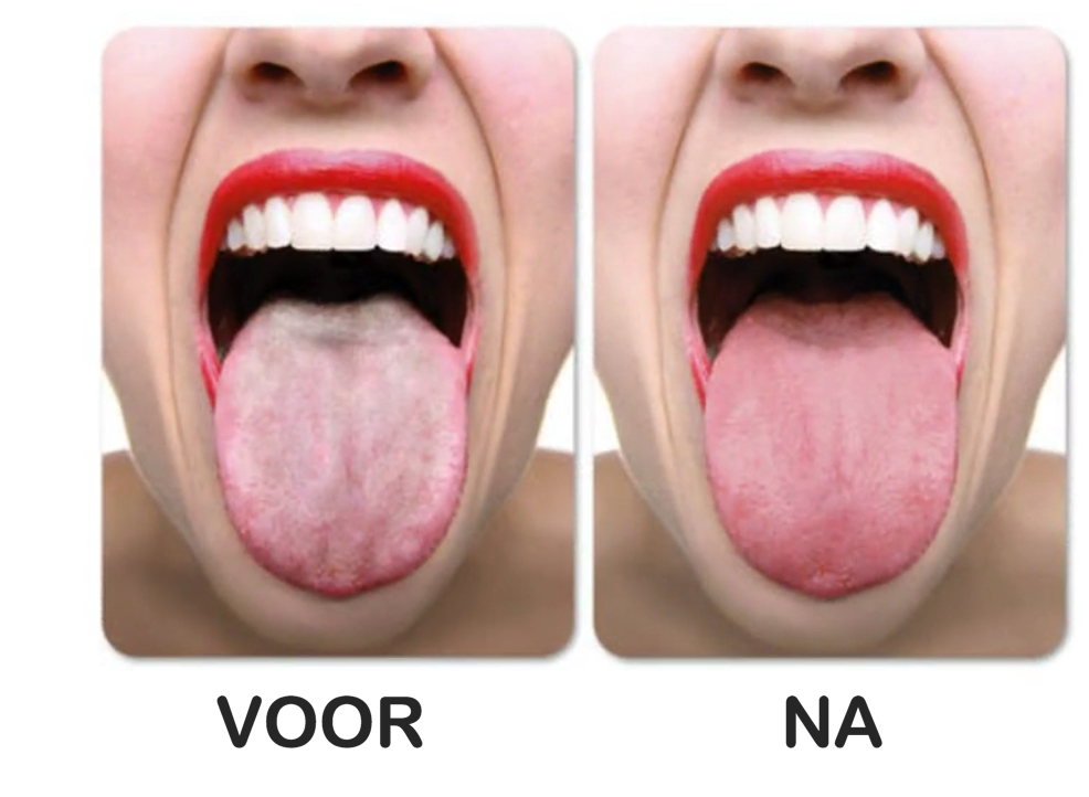 vieze aanslag tong