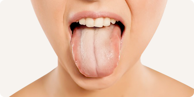 Hoe verwijder je witte aanslag op de tong?
